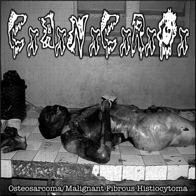 CxAxNxCxRxOx - Osteosarcoma/Malignant Fibrous Histiocytoma download mp3 flac