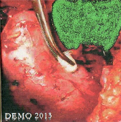 Gynaecological Tumours In The Uterine Wall Accompanying Fatal & Damaging Complications - Demo 2013 download mp3 flac