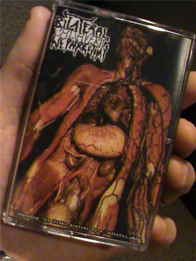 Bilateral Cadaveric Nephrectomy - Exposing The Human Anatomy By A Sadistic Way download mp3 flac