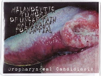 Melanocytic Tumors Of Uncertain Malignant Potential - Oropharyngeal Candidiasis download mp3 flac